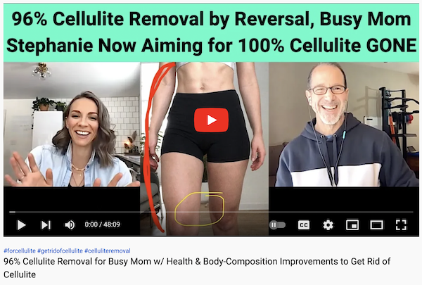 96 Percent Cellulite Removal for Busy Mom Plus Toning and Body-Composition Improvements